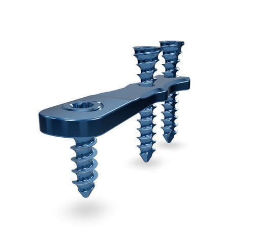 Kompressionsplatte für Hallux Valgus - HV 2.7 - Astrolabe - mit Verriegelung / Titan