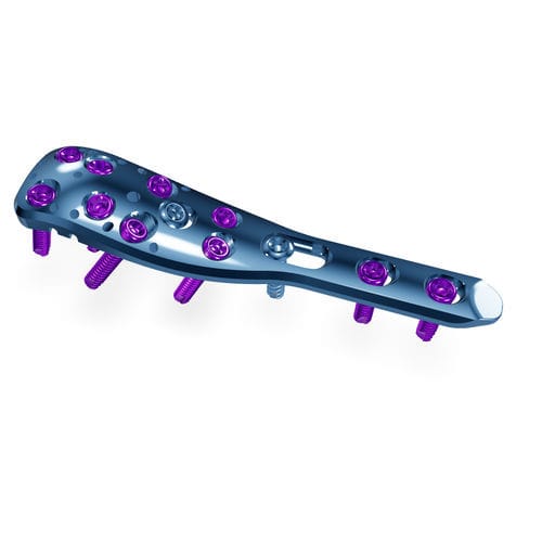 Kompressionsplatte für Humerus - PH system - Astrolabe - proximal / mit Verriegelung / Titan