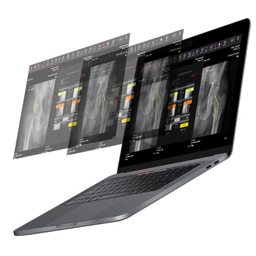 Software für Hüftchirurgie - HIPPO™ - Imagebiopsy Lab - Bildanalyse / Reporting / Visualisierung