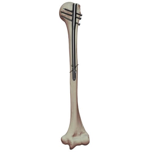 Marknagel / Humerus - NUNA - Dunitech - mit diaphysärer Fixierung / mit proximaler Fixierung / rechts