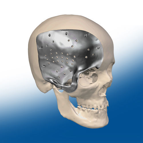 Patientenspezifisches Schädelimplantat - Ortho Baltic Implants