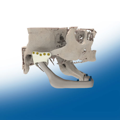 Patientenspezifisches Kiefergelenkimplantat - TMJ - Ortho Baltic Implants