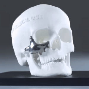 Patientenspezifisches Orbitalimplantat - Ortho Baltic