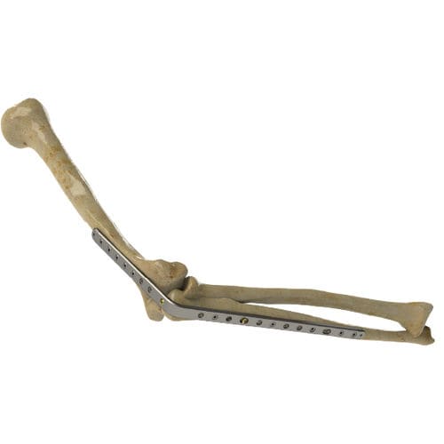 Arthrodeseplatte für Ellbogen - 1222-0010 - Zimed Medical - mit Verriegelung / Metall