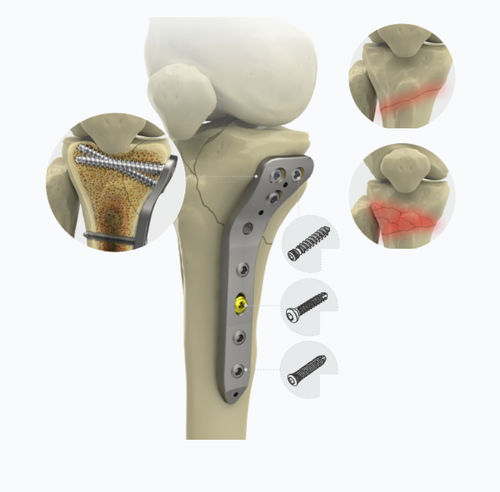 Proximale Kompressionsplatte - 1572 series - Zimed Medical - für Tibia / medial / mit Verriegelung