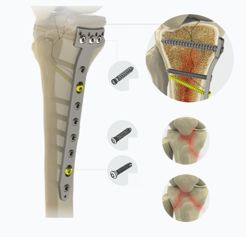Proximale Kompressionsplatte - 1792 series - Zimed Medical - für Tibia / medial / mit Verriegelung