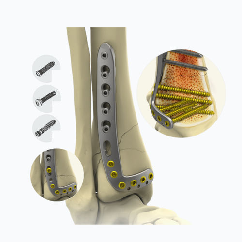 Kompressionsplatte für Tibia - 10132 series - Zimed Medical - distal / anterolateral / mit Verriegelung