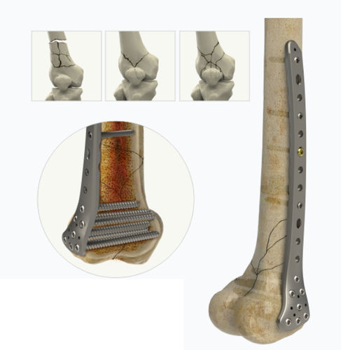 Kompressionsplatte für Oberschenkelknochen - 1542 series - Zimed Medical - distal / seitlich / mit Verriegelung