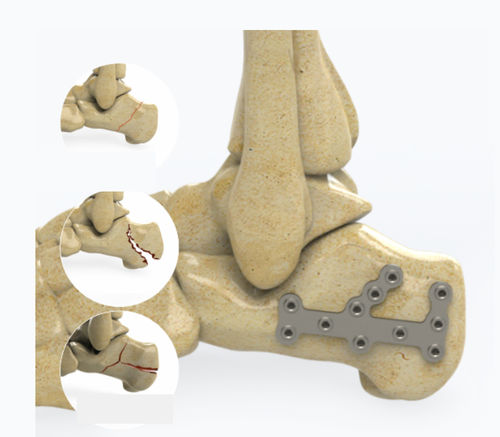 Kompressionsplatte für Calcaneum - 1602 series - Zimed Medical - mit Verriegelung / Metall