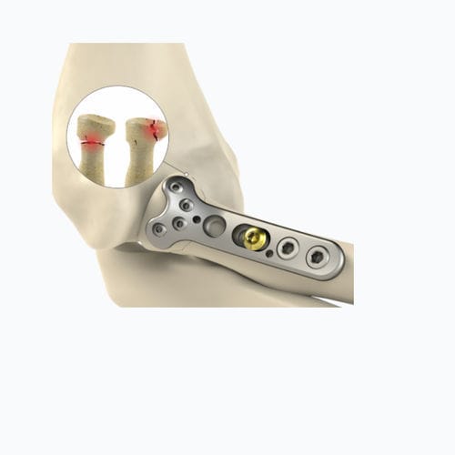 Kompressionsplatte für Radius - 8762 series - Zimed Medical - für Radiuskopf / proximal / mit Verriegelung