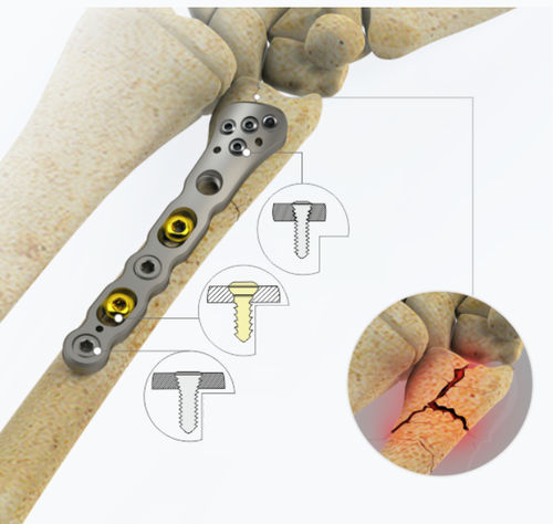 Kompressionsplatte für Ulna - 8732 series - Zimed Medical - distal / mit Verriegelung / Metall
