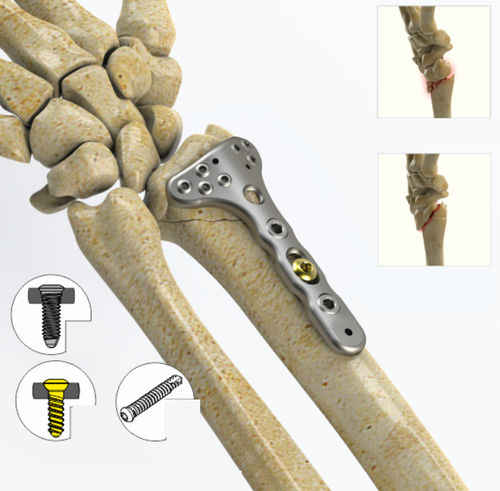 Kompressionsplatte für Radius - 1992 series - Zimed Medical - distal / dorsal / mit Verriegelung