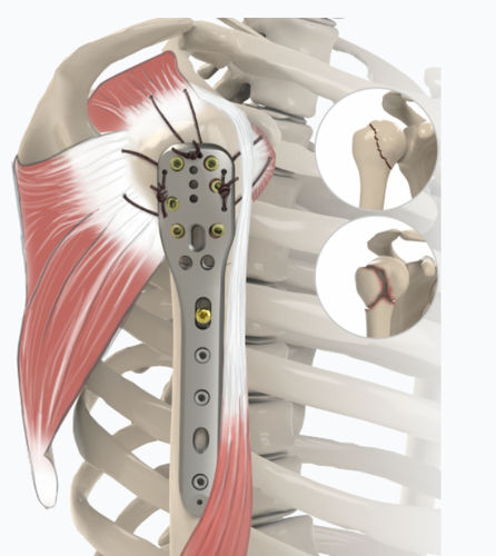 Kompressionsplatte für Humerus - 1832 series - Zimed Medical - proximal / seitlich / mit Verriegelung