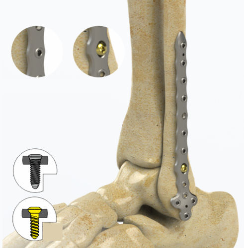 Kompressionsplatte für Fibula - 1852 series - Zimed Medical - distal / mit Verriegelung / Metall