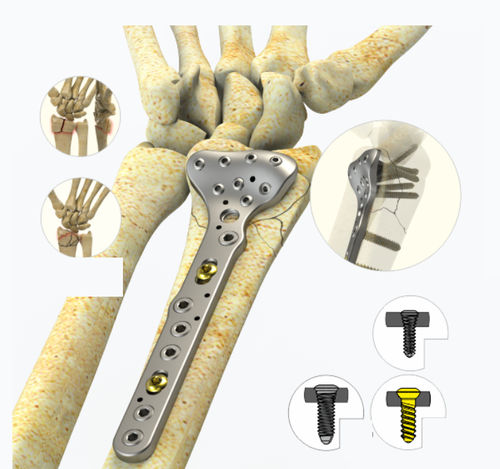 Kompressionsplatte für Radius - 9922 series - Zimed Medical - distal / mit Verriegelung / Metall