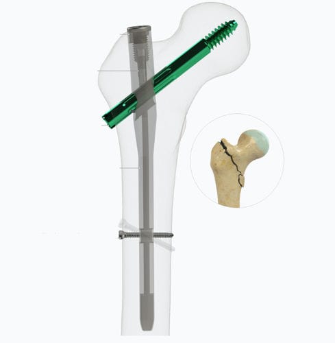 Marknagel für Oberschenkelknochen - Zimed Medical - mit proximaler Fixierung / Metall