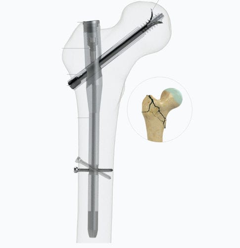 Marknagel für Oberschenkelknochen - Zimed Medical - mit proximaler Fixierung / rechts / links