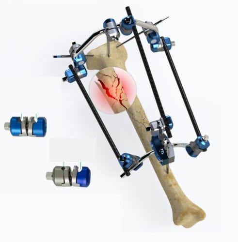 Fixateur externe / für Tibia - Zimed Medical - rohrförmig / für Erwachsene