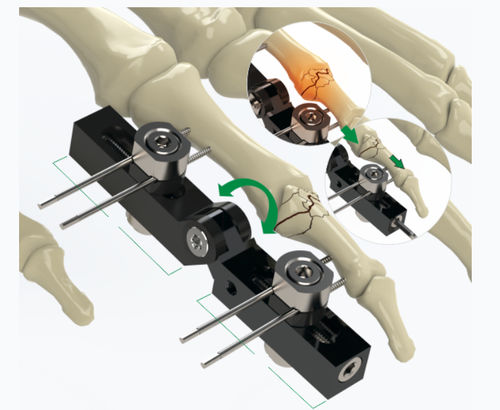 Fixateur externe für Fingergrundgelenk - 5084-0000 - Zimed Medical - rohrförmig / für Erwachsene