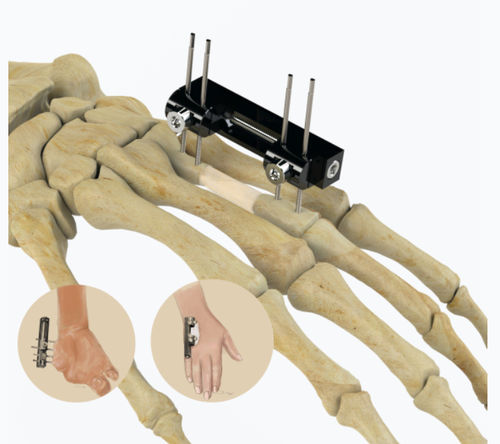 Fixateur externe für Fingergrundgelenk - 5084 series - Zimed Medical - rohrförmig / für Erwachsene