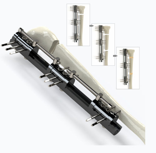 Fixateur externe / für Tibia - 5074 series - Zimed Medical - rohrförmig / für Erwachsene