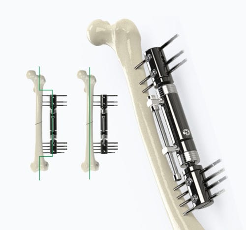 Fixateur externe / für Oberschenkelknochen - 5014 series - Zimed Medical - rohrförmig / für Erwachsene