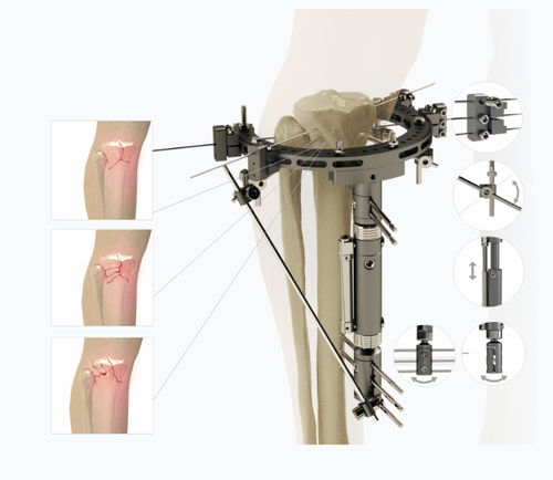 Fixateur externe / für Tibia - 5254 series - Zimed Medical - für Oberschenkelknochen / hybrid / für Erwachsene