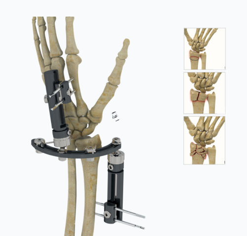 Fixateur externe / für Handgelenk - 5134-0000  - Zimed Medical - hybrid / für Erwachsene