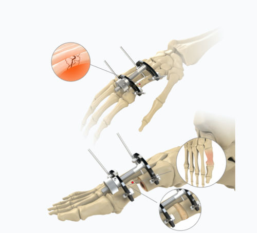 Fixateur externe für Fingergrundgelenk - 5784-0000	 - Zimed Medical - für Metatarsophalangealgelenk / hybrid / für Erwachsene