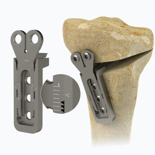 Osteotomieplatte für Tibia - 1972-0016 - Zimed Medical - mit Verriegelung / Metall