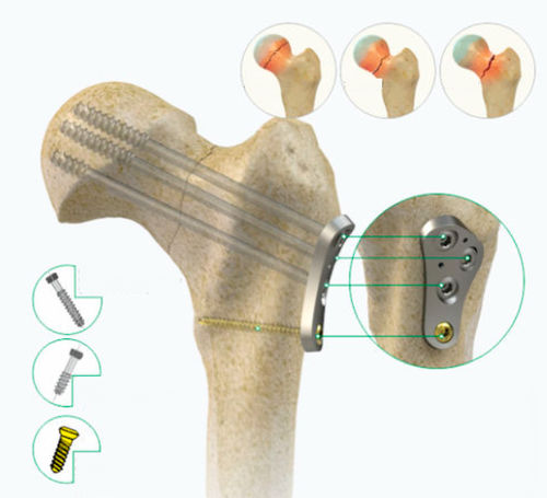 Kompressionsplatte für Hüftkopf - Zimed Medical - proximal / seitlich / mit Verriegelung