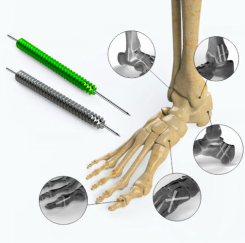 Knochen-Kompressionsschraube / für Fuß - Zimed Medical - kanüliert / ohne Kopf