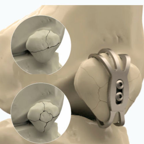 Kompressionsplatte für Patella - 1072 series - Zimed Medical - mit Verriegelung / Metall