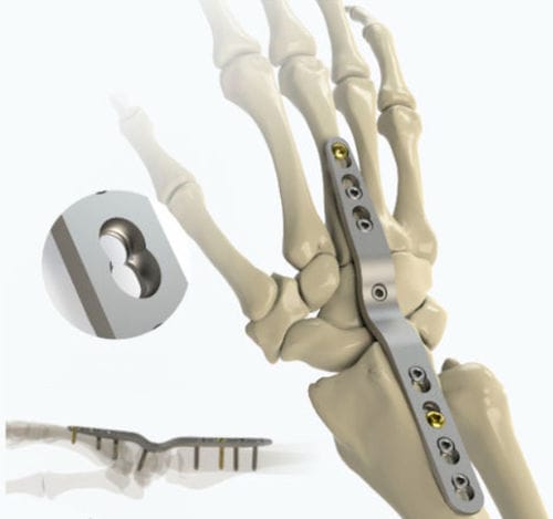 Arthrodeseplatte für Handwurzelknochen - 1022-0008 - Zimed Medical - mit Verriegelung / Metall