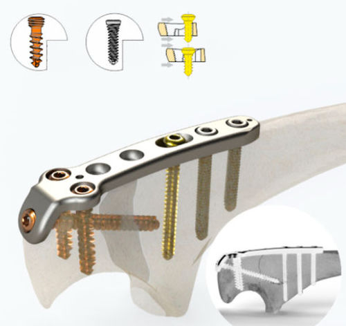 Kompressionsplatte für Ulna - 1662 series - Zimed Medical - für Olekranon / proximal / mit Verriegelung