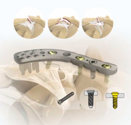 Kompressionsplatte für Schlüsselbein - 1492 series - Zimed Medical - distal / mit Verriegelung / Metall