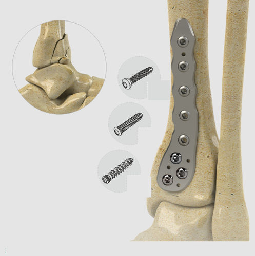 Kompressionsplatte für Tibia - 1582 series - Zimed Medical - distal / seitlich / mit Verriegelung