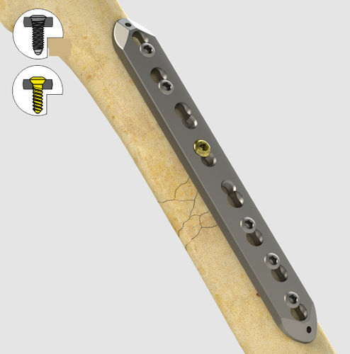 Kompressionsplatte für große Knochenfragmente - 1372 series - Zimed Medical - medial / mit Verriegelung / Metall