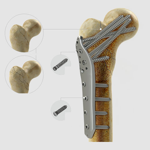 Kompressionsplatte für Oberschenkelknochen - 1552 series - Zimed Medical - proximal / seitlich / mit Verriegelung
