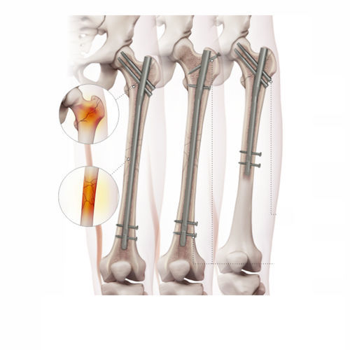 Marknagel für Oberschenkelknochen - 4602-0918 - Zimed Medical - mit proximaler Fixierung / mit distaler Fixierung / rechts