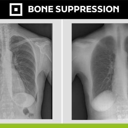 Medizinische Software - Bone Suppression - Digitec - Röntgen / Diagnose / Nachbearbeitung