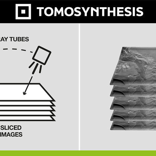 Medizinische Software - Digital Tomosynthesis - Digitec - Röntgen / Diagnose / Nachbearbeitung