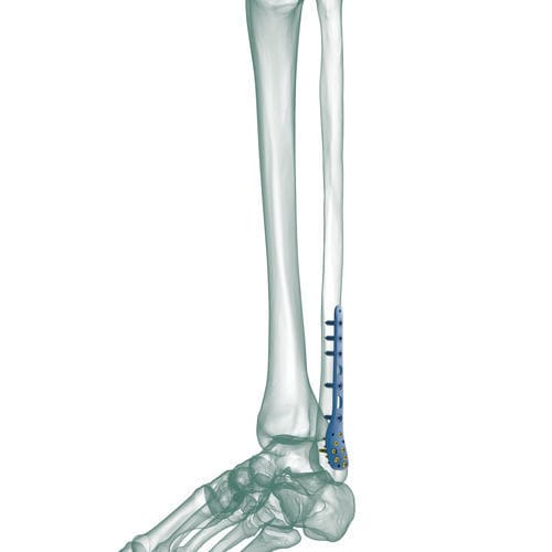 Kompressionsplatte für Fibula - TRUE LOCK Distal Fibula Posterolateral - Truemed Medical - distal / dorsolateral / mit Verriegelung