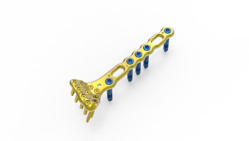 Kompressionsplatte für Handgelenk - TRUE LOCK  - Truemed Medical - distal / mit Verriegelung / Metall