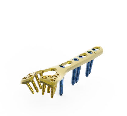Kompressionsplatte für Radius - TRUE LOCK  - Truemed Medical - distal / dorsal / mit Verriegelung