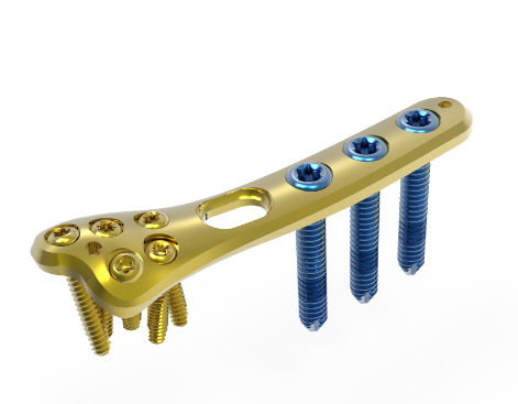 Kompressionsplatte für Ulna - TRUE LOCK  - Truemed Medical - distal / mit Verriegelung / Metall