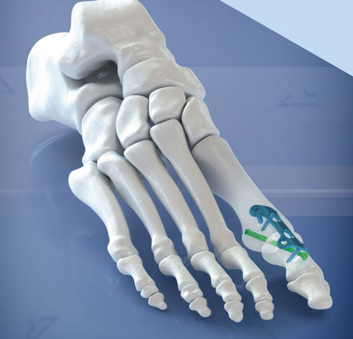 Arthrodeseplatte für Hallux Valgus - 400108 series - AGOMED Medizin-Technik - für Vorfuß / mit Verriegelung / Titan
