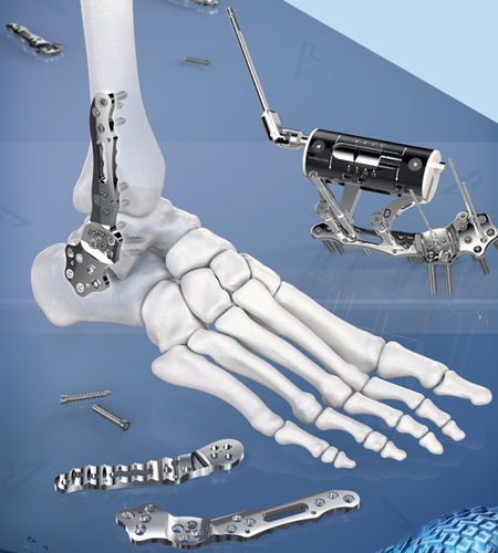 Arthrodeseplatte für Knöchel - AGOFIX - AGOMED Medizin-Technik - anterolateral / mit Verriegelung / ohne Verriegelung