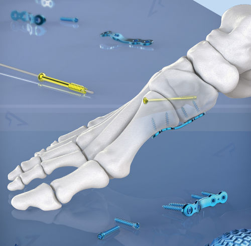Arthrodeseplatte für Hallux Valgus - AGOMED Medizin-Technik - für Metatarsalknochen / dorsal / medial