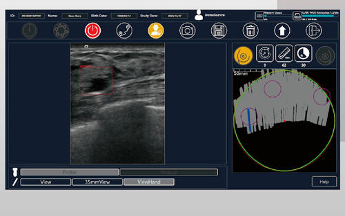 Software für Ultraschalluntersuchungen - BR-FHUS Navigation™ - TaiHao Medical - Viewer / Diagnose / zur Brustkrebs-Früherkennung